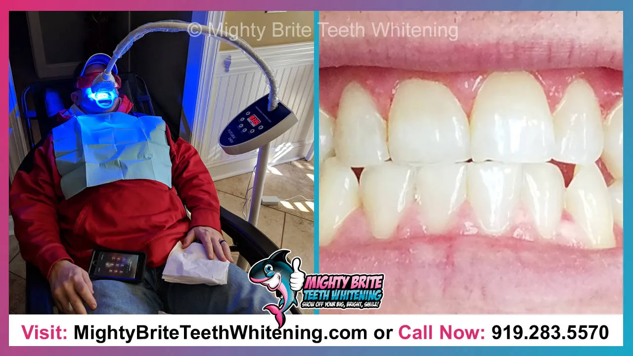 29209 in office teeth whitening
