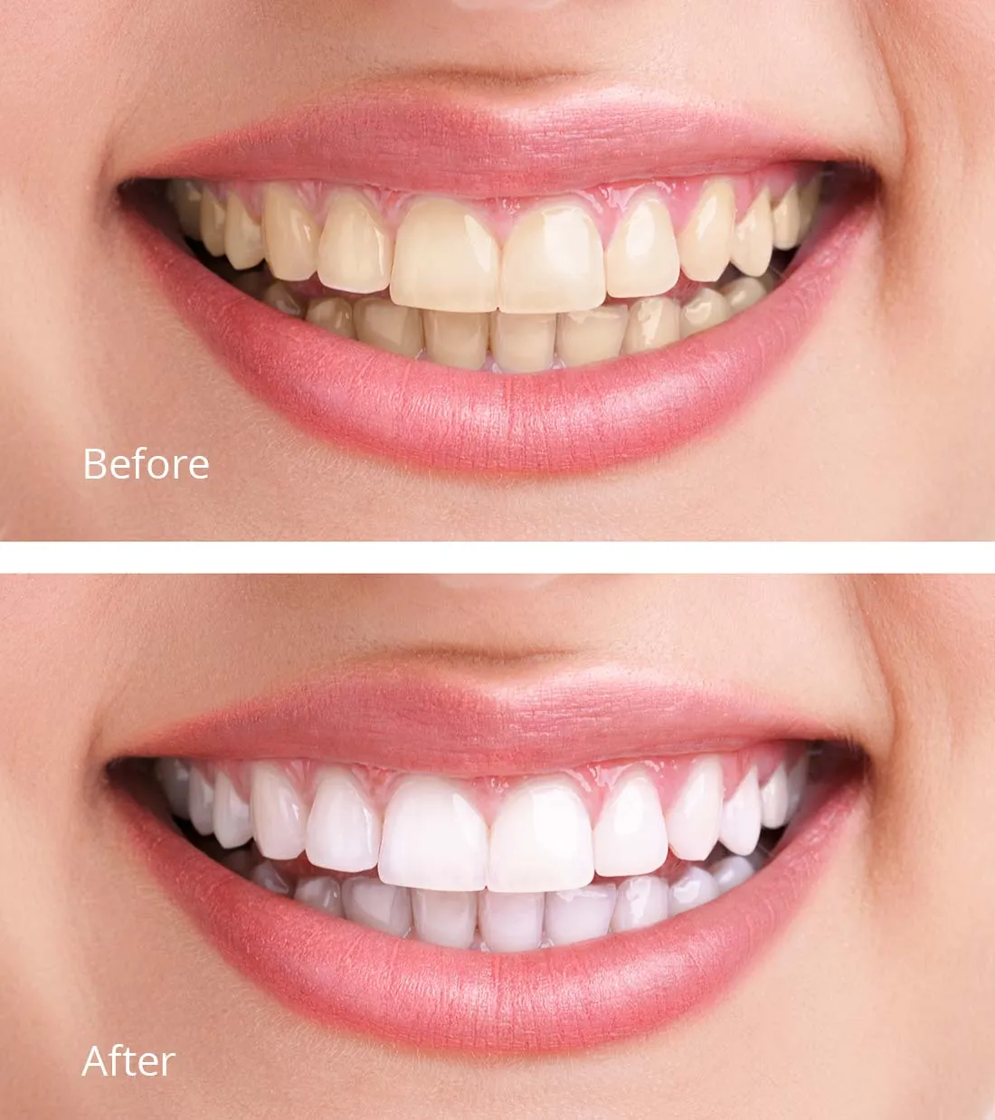 29209 teeth whitening procedure
