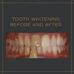 /img/29213-laser-teeth-whitening-pittsburgh-cost.webp