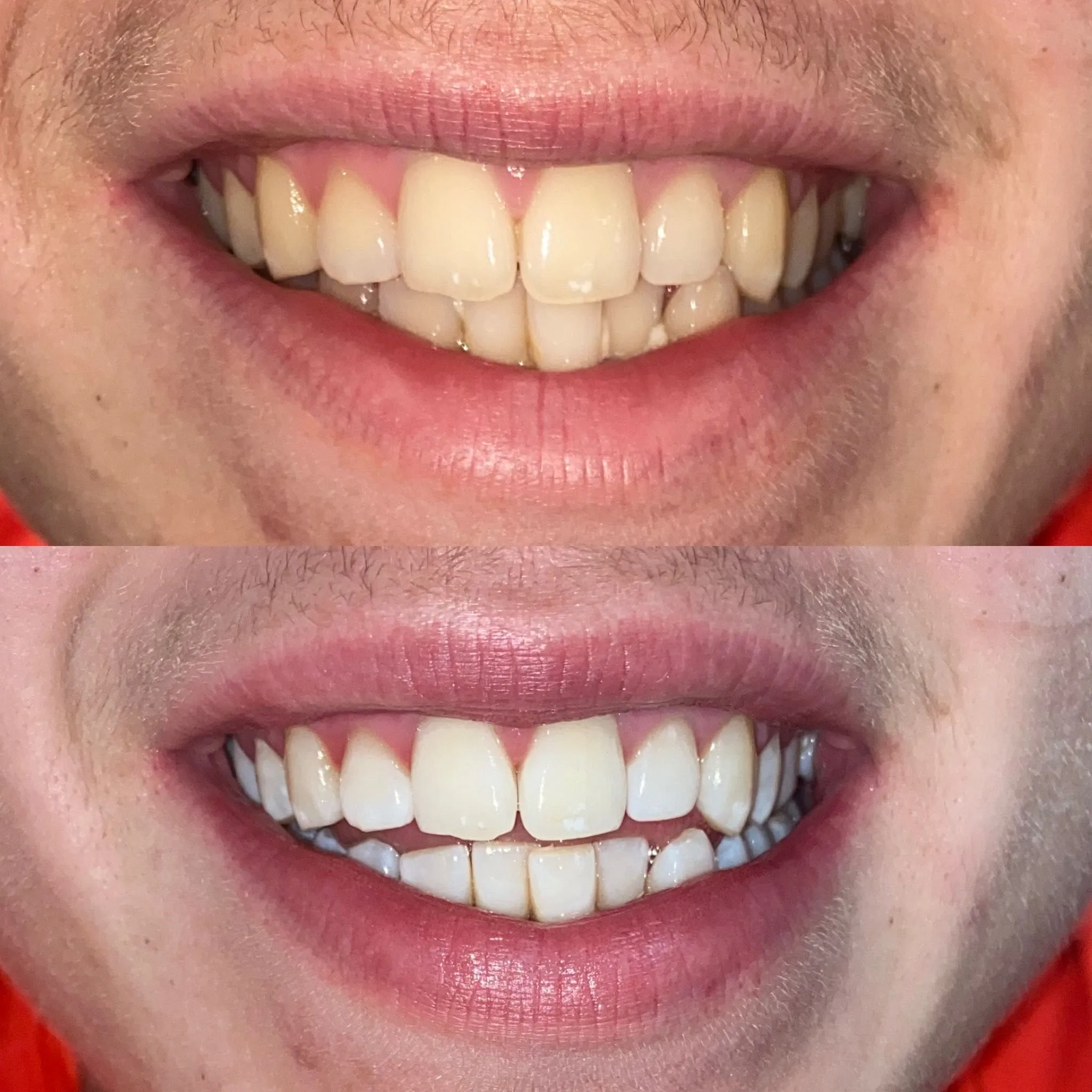 29213 laser teeth whitening pittsburgh results