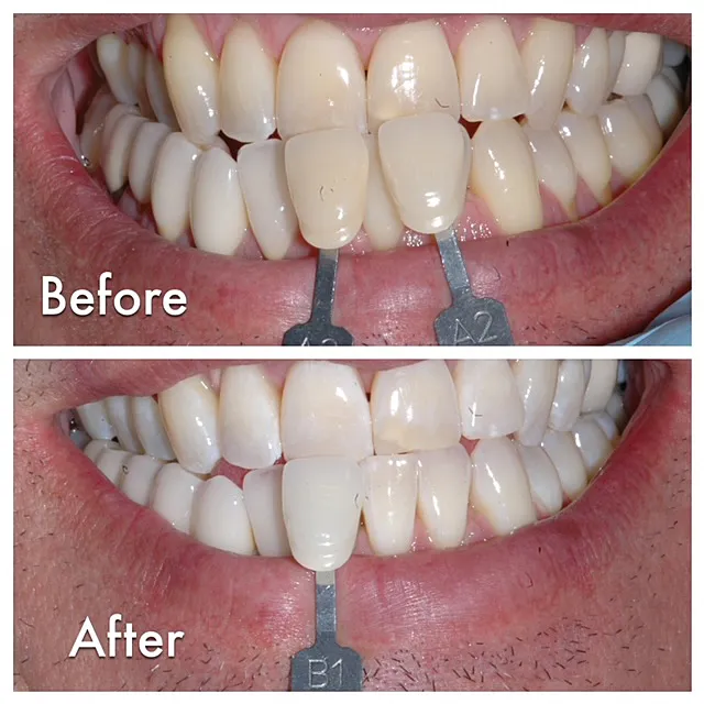 29213 laser teeth whitening procedure pittsburgh