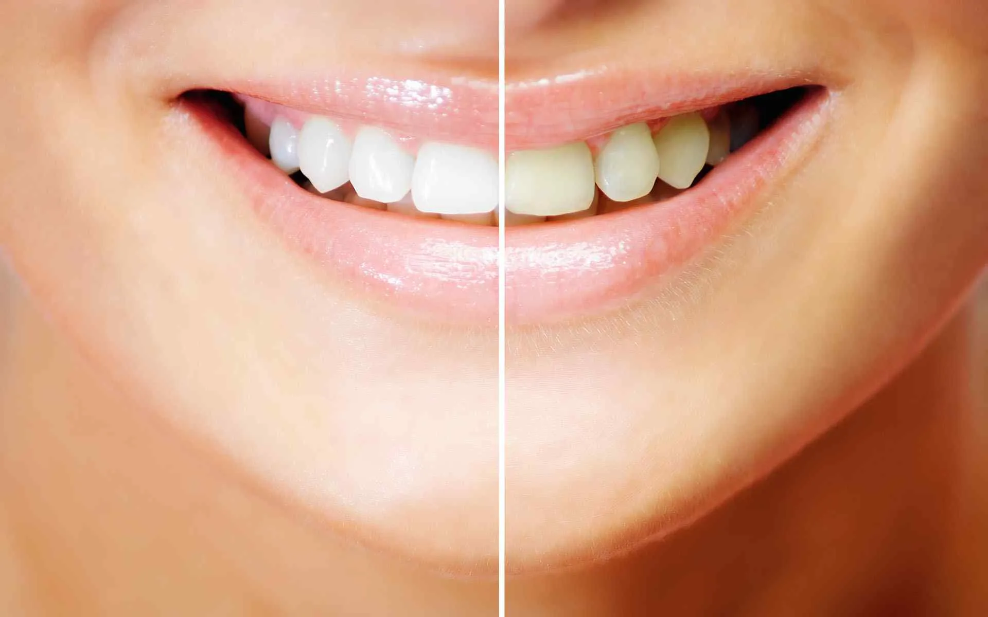 29215 whitening strips damage teeth image3