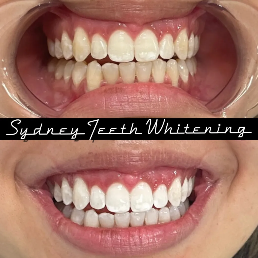 29215 whitening strips damage teeth image4