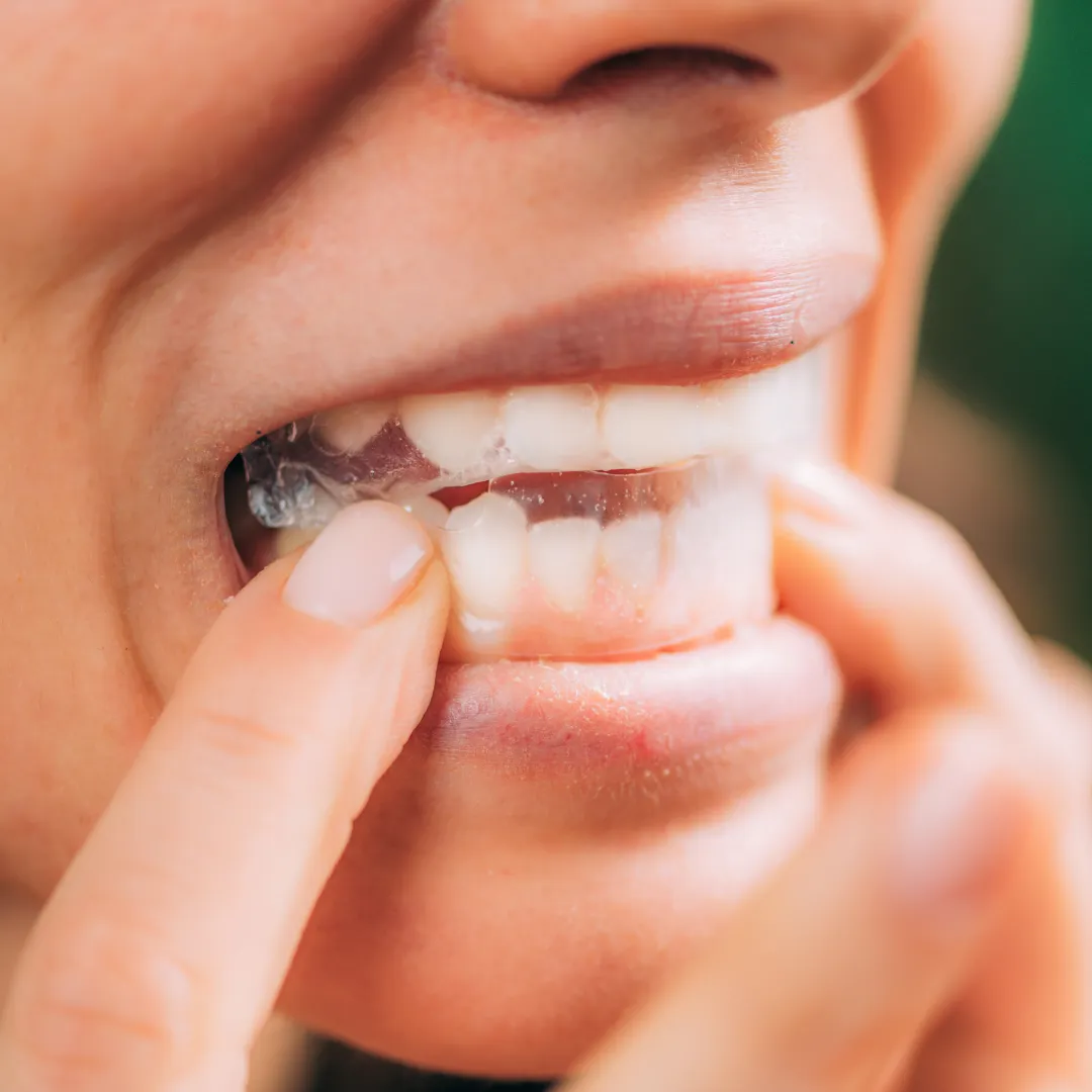 29215 whitening strips damage teeth image5