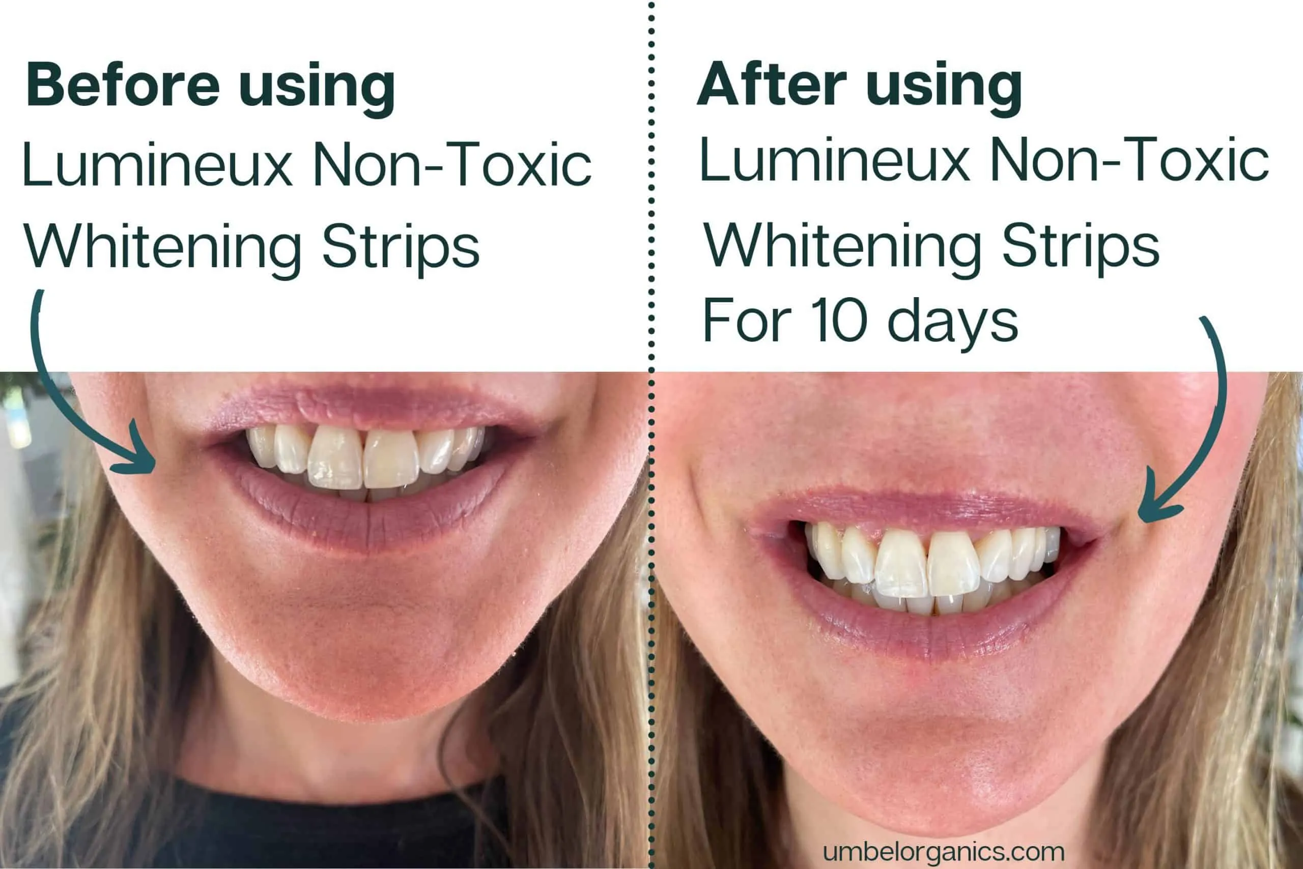29215 whitening strips damage teeth image6