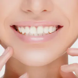 /img/29215-whitening-strips-damage-teeth-image7.webp