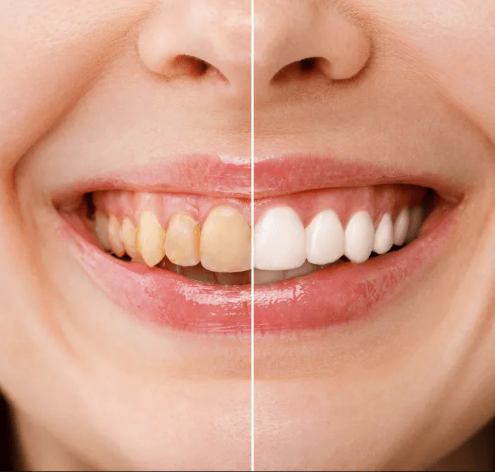 29218 professional teeth whitening