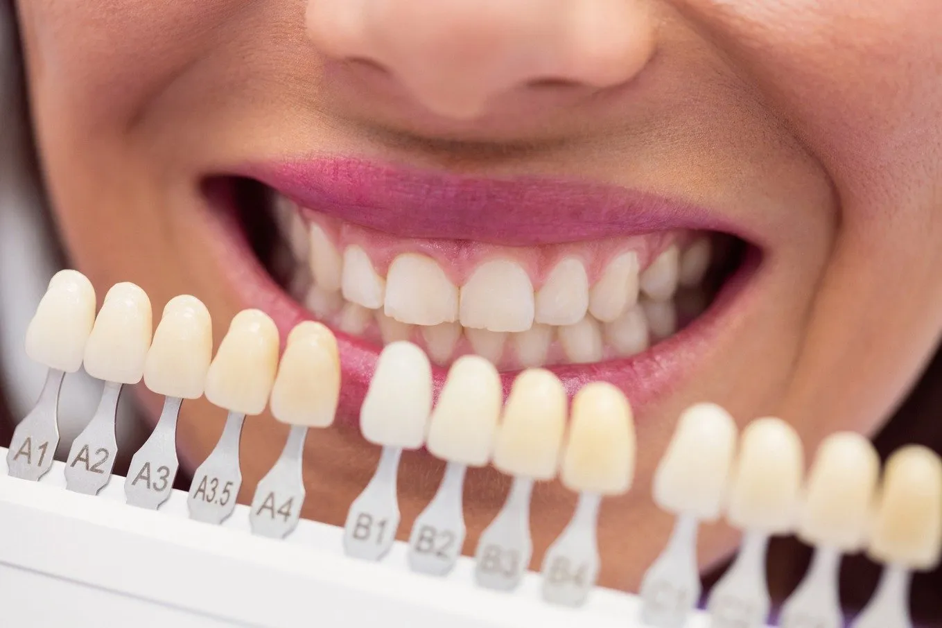 29218 teeth whitening candidates