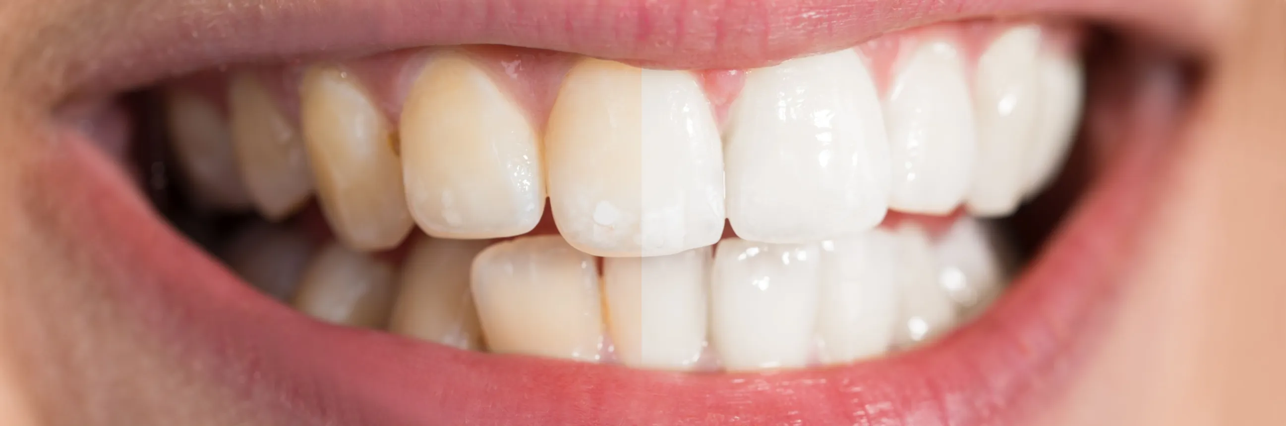 /img/29218-teeth-whitening-reviews.webp