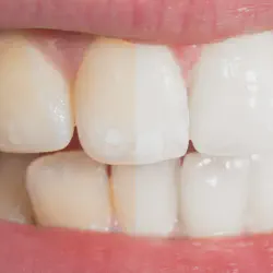 /img/29218-teeth-whitening-reviews.webp