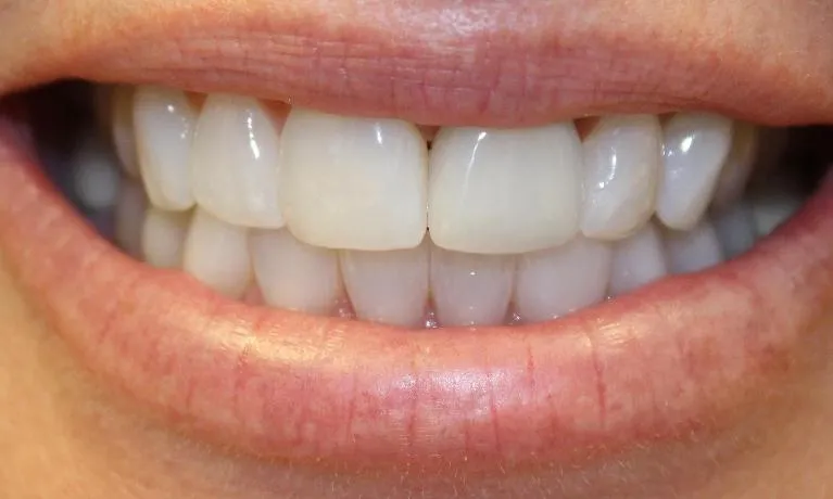 /img/29221-before-and-after-teeth-whitening.webp