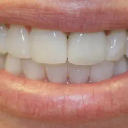 /img/29221-before-and-after-teeth-whitening.webp