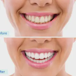/img/29223-avoid-irritants-after-whitening.webp