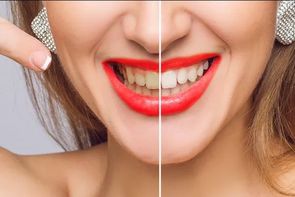 29223 hydration after whitening