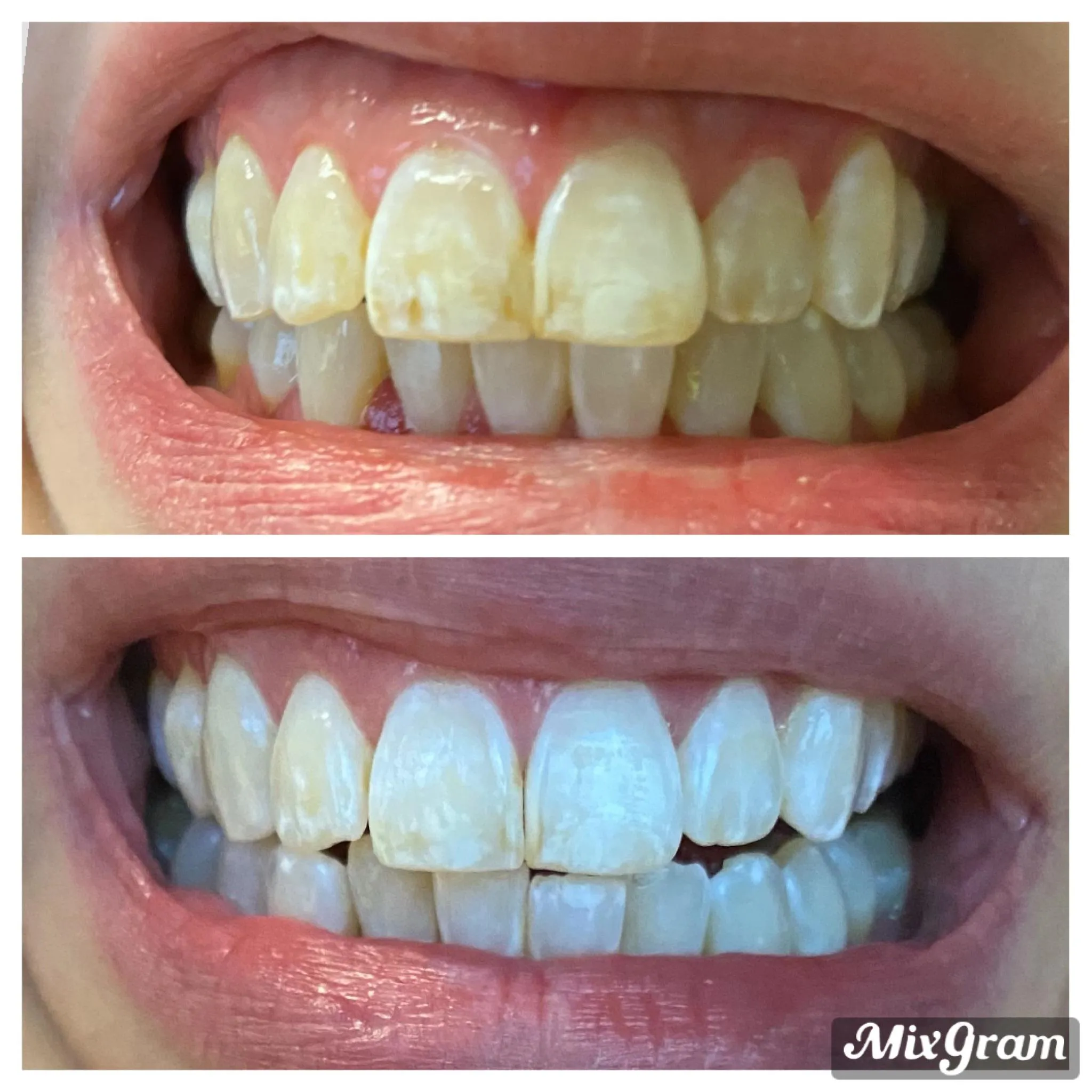 29224 teeth whitening strips application