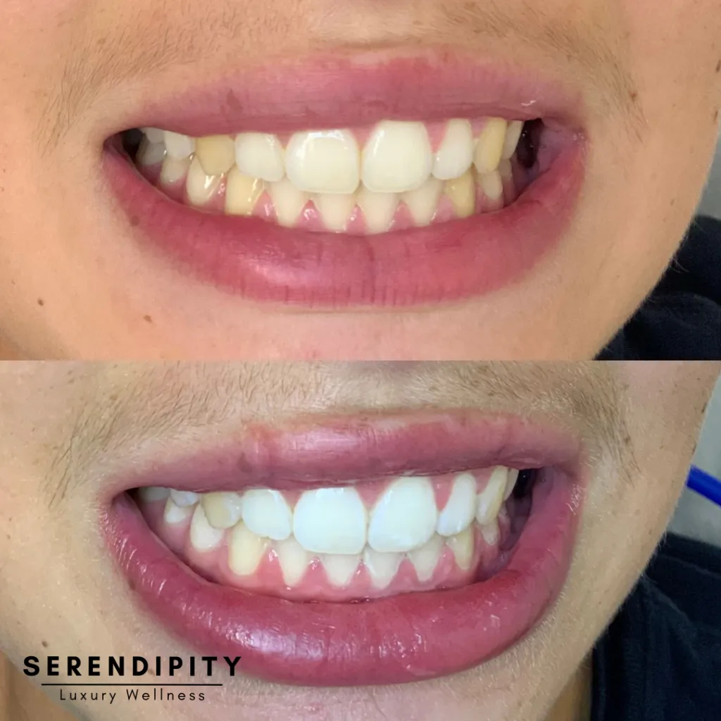 29232 teeth whitening houston 1