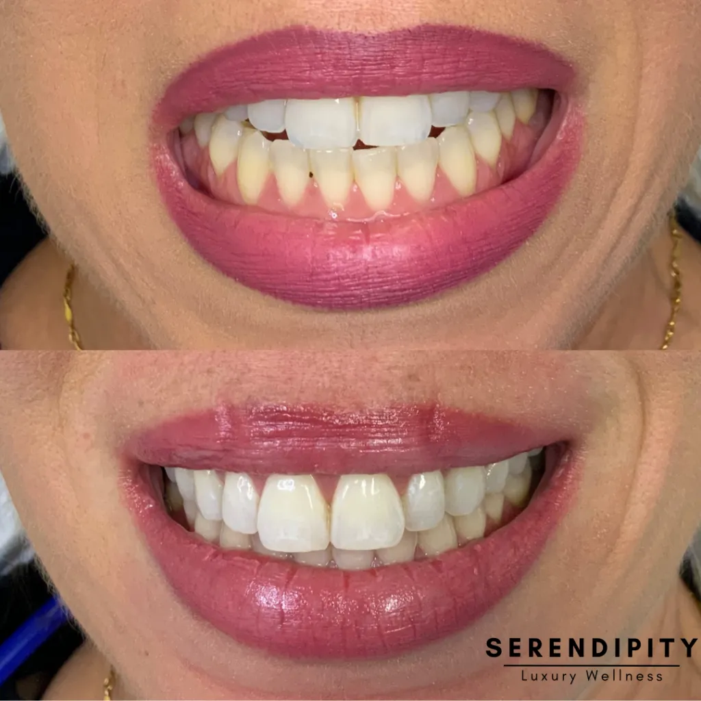 29232 teeth whitening houston 2