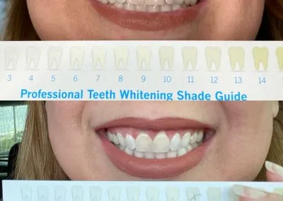 29232 teeth whitening houston 4