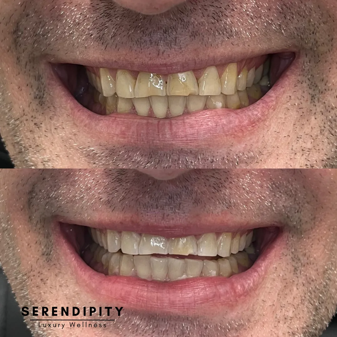 29232 teeth whitening houston 5