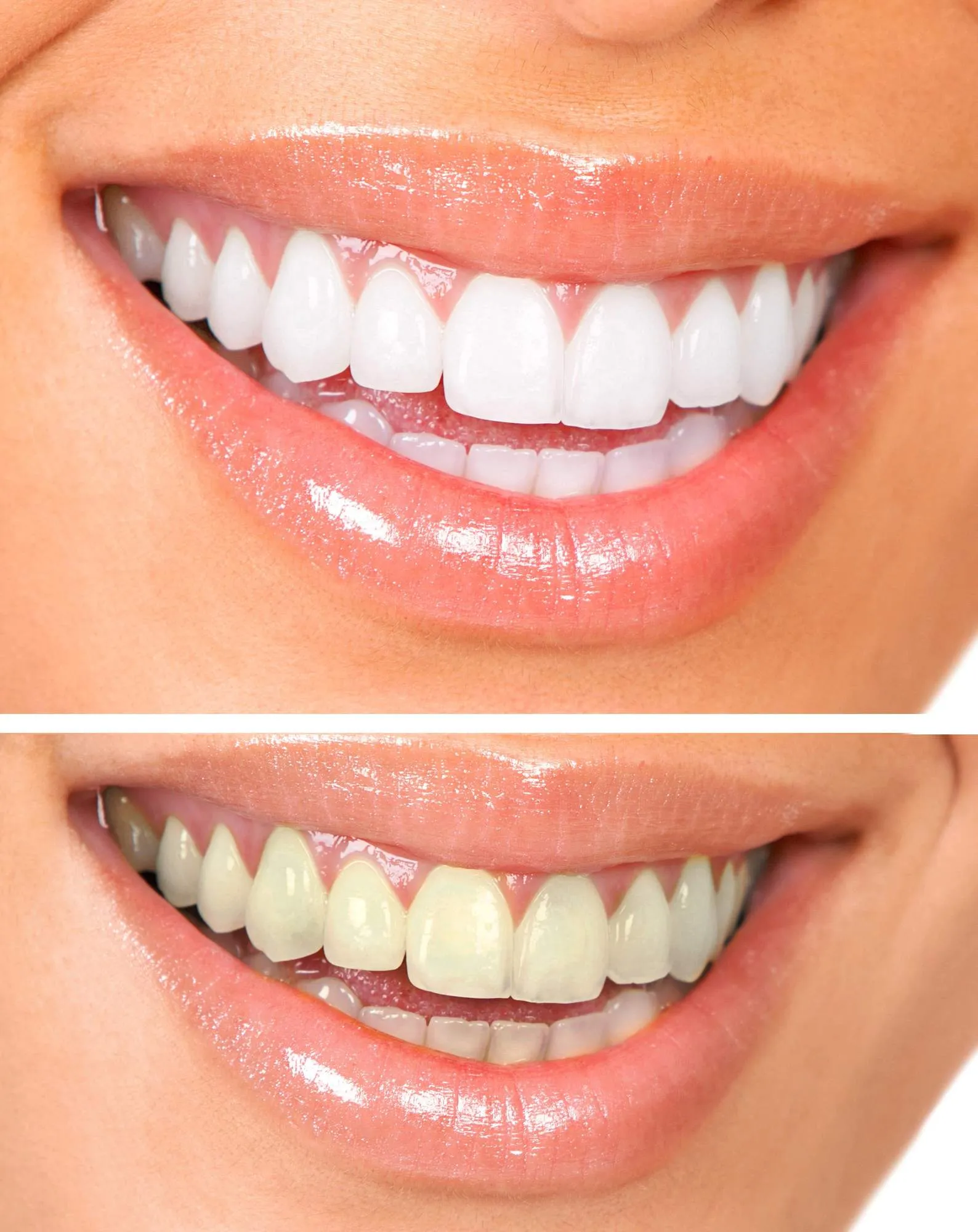 29234 old teeth discoloration