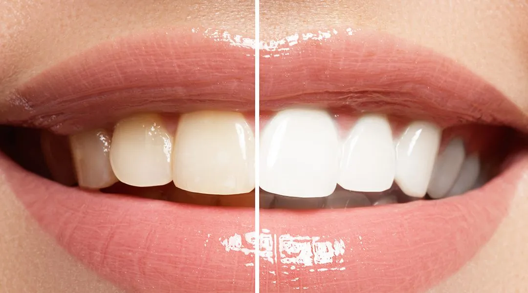 29234 whitening diet