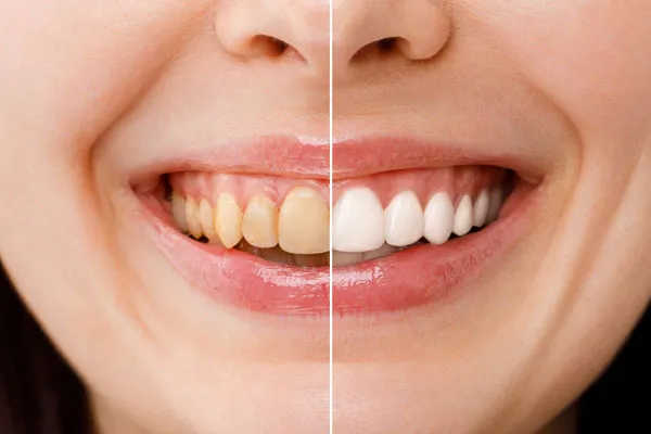 29238 custom tray teeth whitening