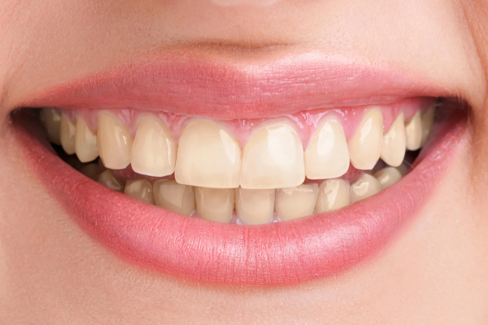 29240 teeth stains types