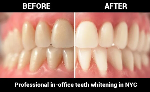 29243 teeth whitening office price 1