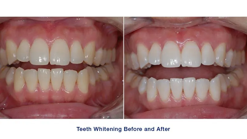 29243 teeth whitening office price 2