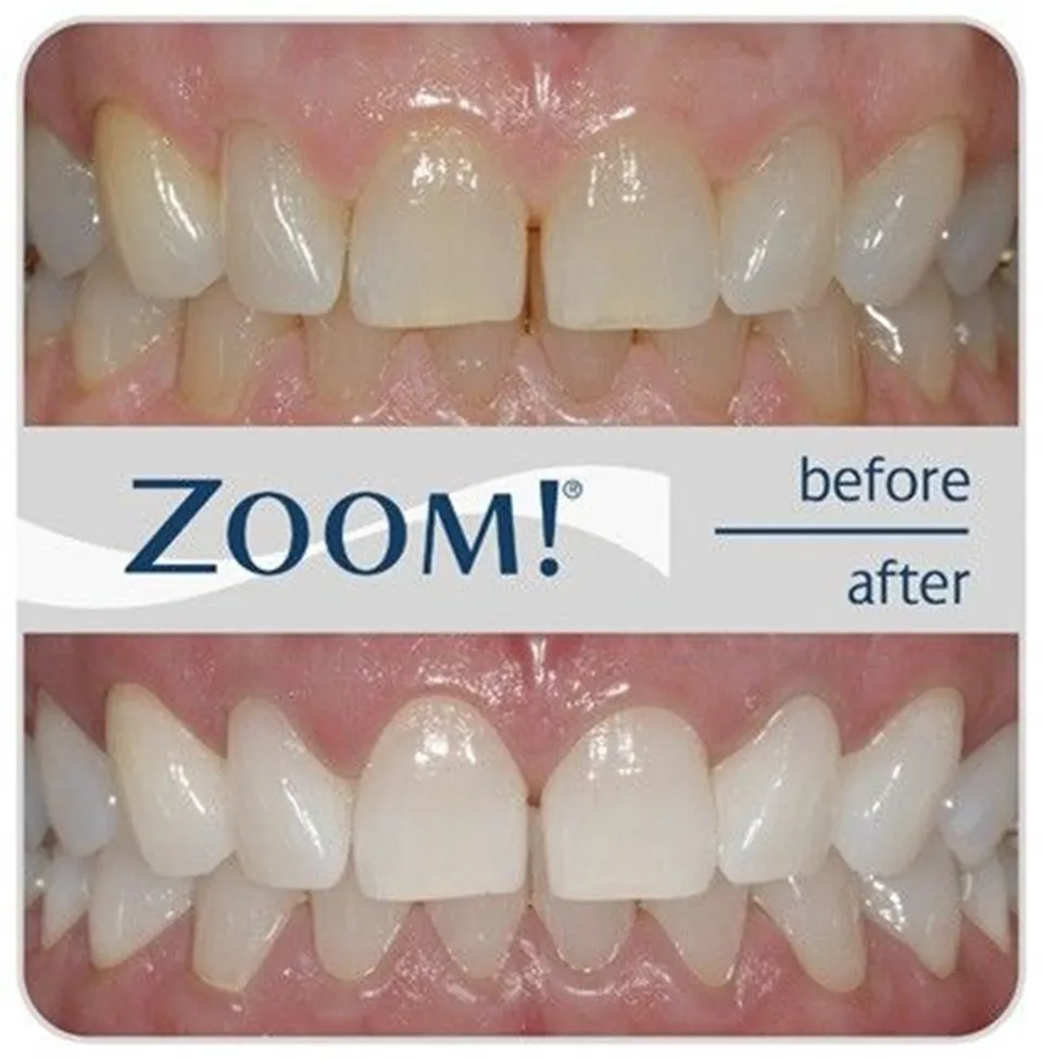 29243 teeth whitening office price 6
