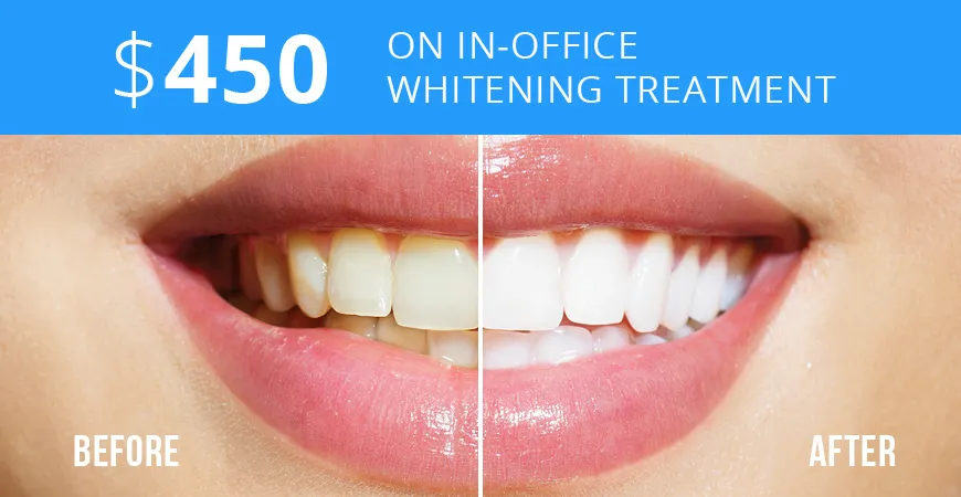 /img/29243-teeth-whitening-office-price-7.webp