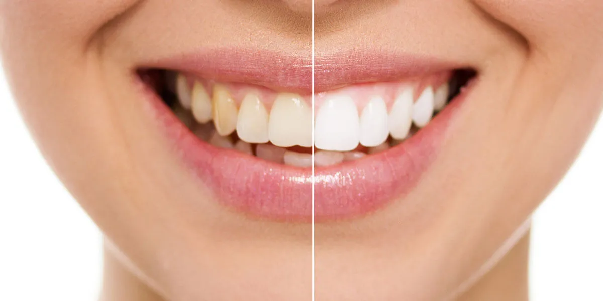 29244 teeth whitening procedures