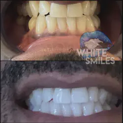 /img/29244-teeth-whitening-results.webp
