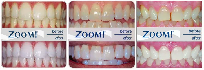 29247 zoom teeth whitening before after