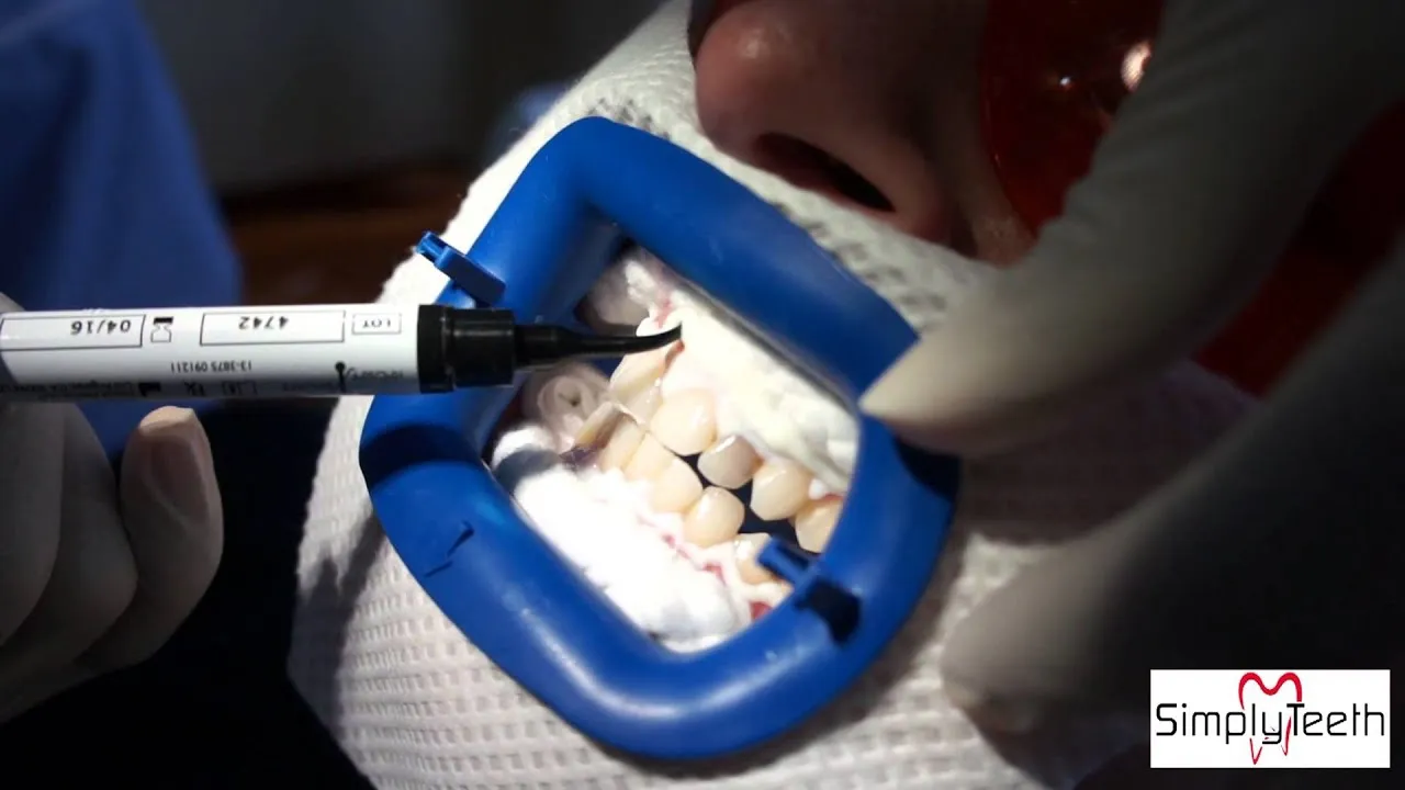 29247 zoom teeth whitening professional