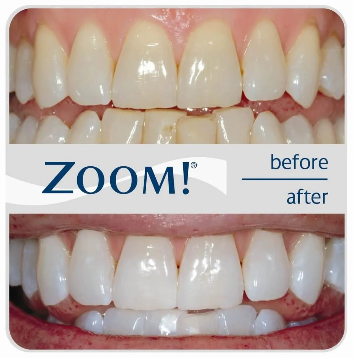 29247 zoom teeth whitening results