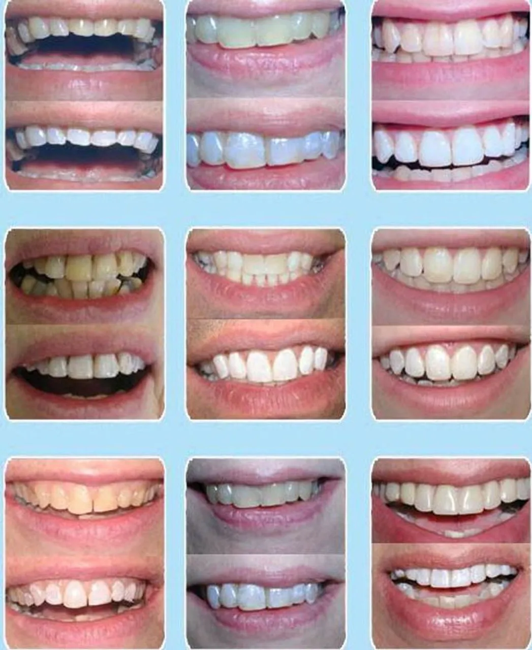 29249 teeth whitening comparison