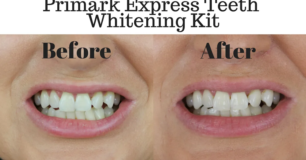 29249 teeth whitening cons