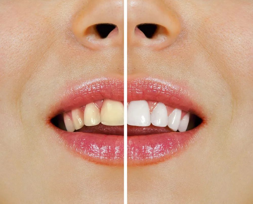 29252 whitening methods