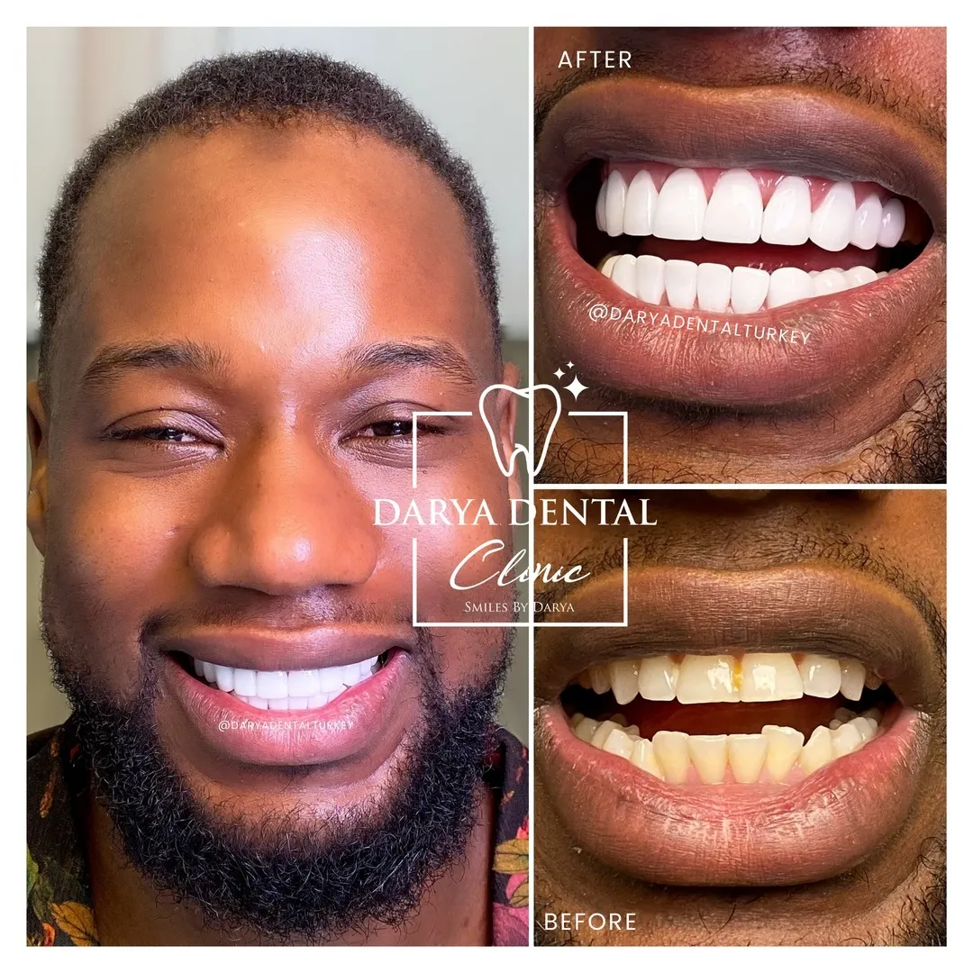 29253 at home teeth whitening johannesburg
