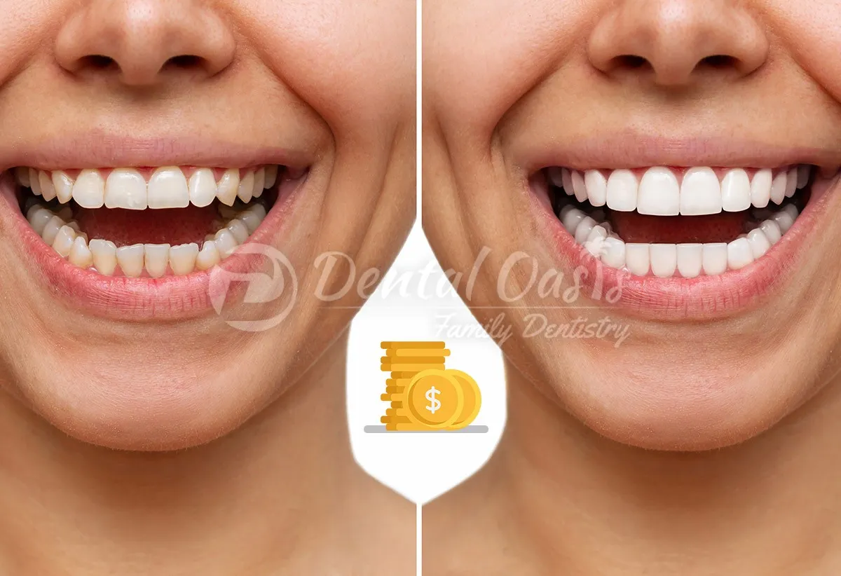 29253 teeth whitening options johannesburg