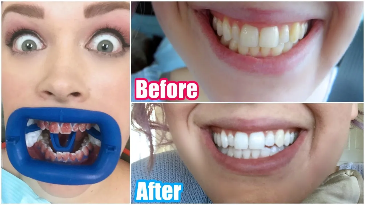 29255 whitening foods avoid