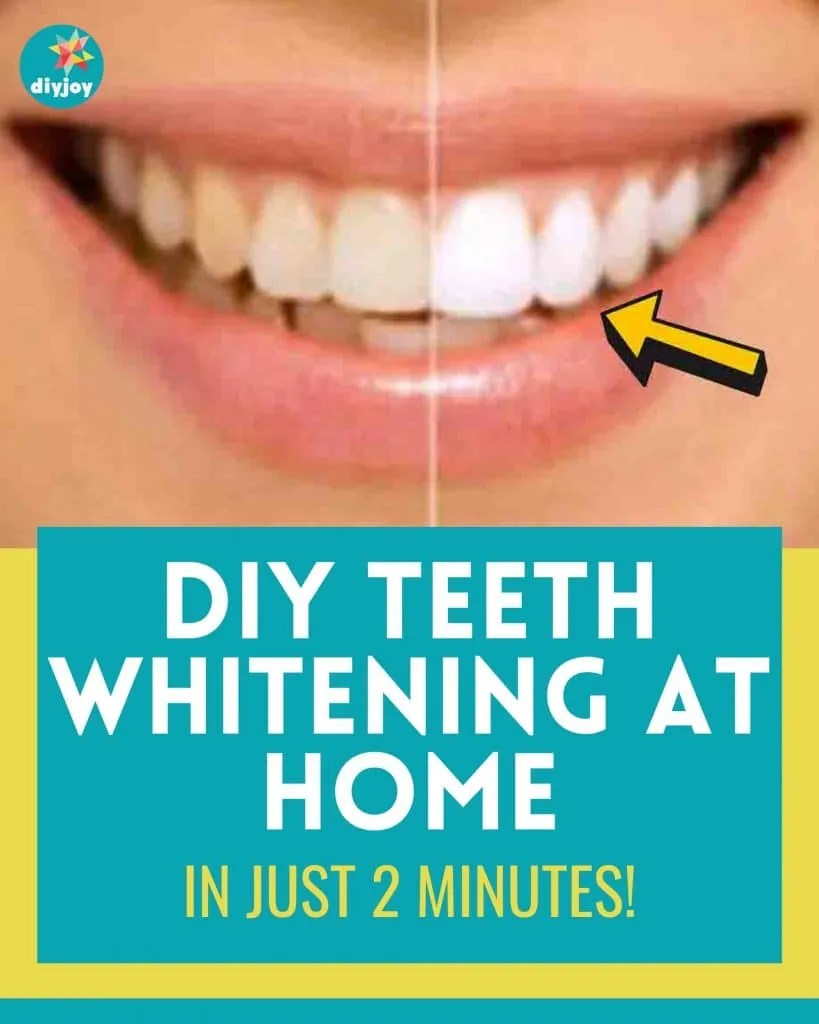 29265 teeth whitening basics