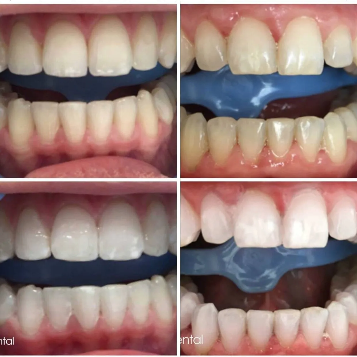 29266 foods to avoid teeth whitening