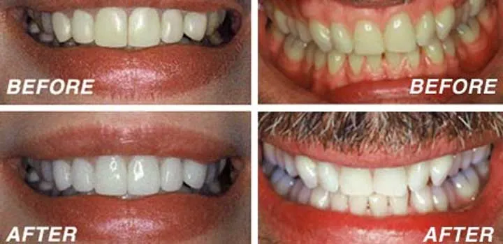 29266 home teeth whitening kit dublin
