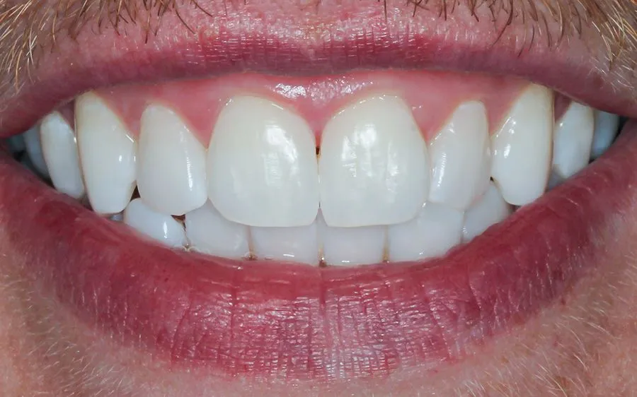 29266 teeth whitening myths dublin