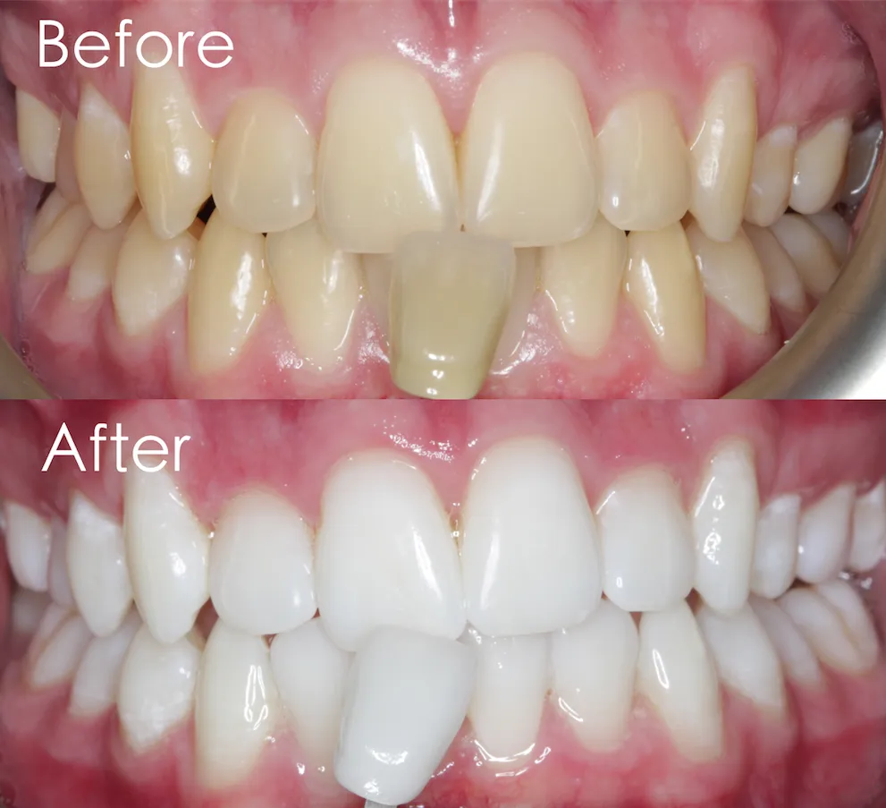 /img/29267-teeth-whitening-aftercare.webp