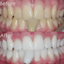/img/29267-teeth-whitening-aftercare.webp
