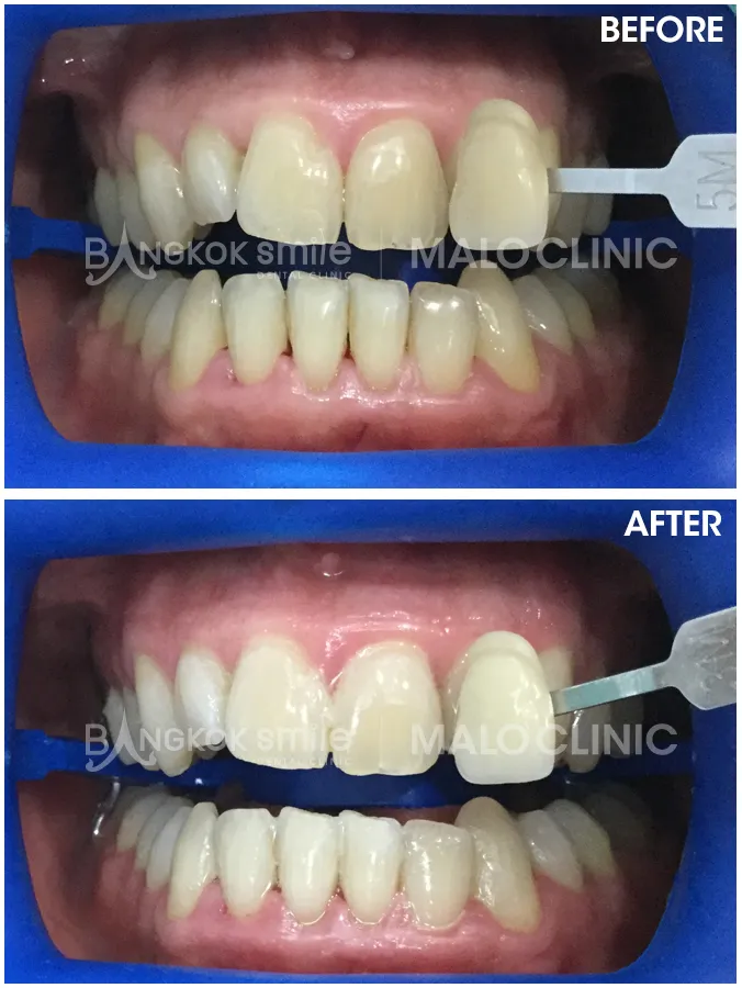 29267 teeth whitening bangkok overview