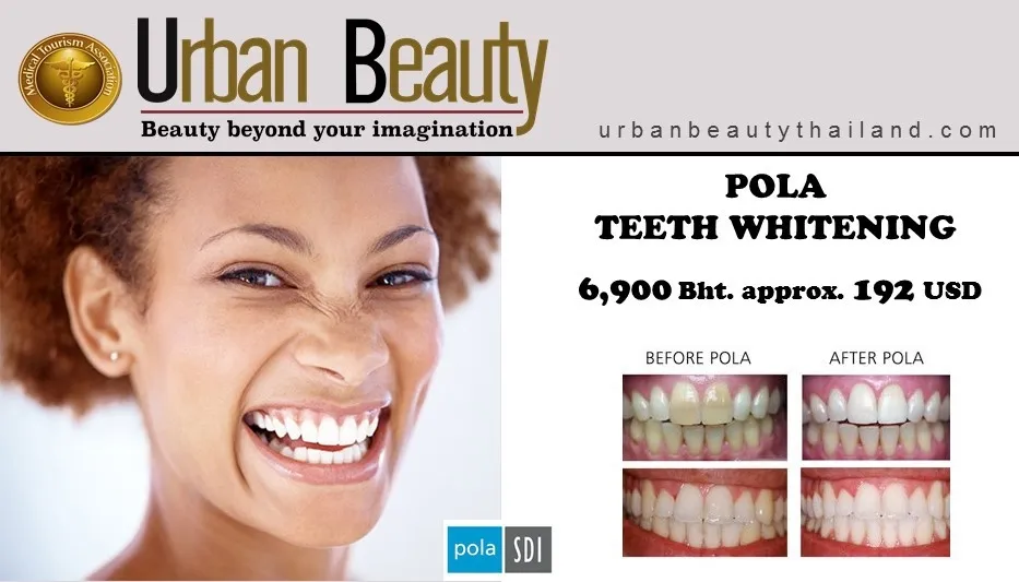 29267 teeth whitening before after